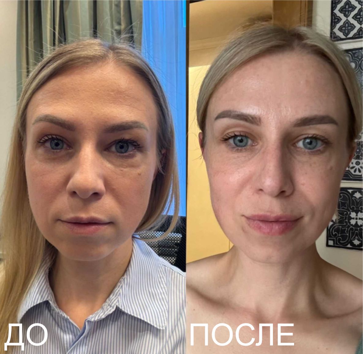 Изображение до процедуры и после процедуры